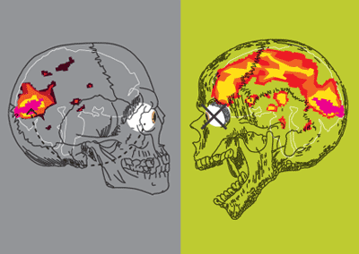 Free Your Mind? Your Brain On LSD